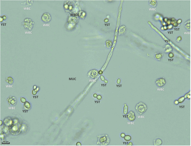 Urine routine microscopy on automated analyzer showing yeast forms and fungal hyphae with pus (WBC) cells.
