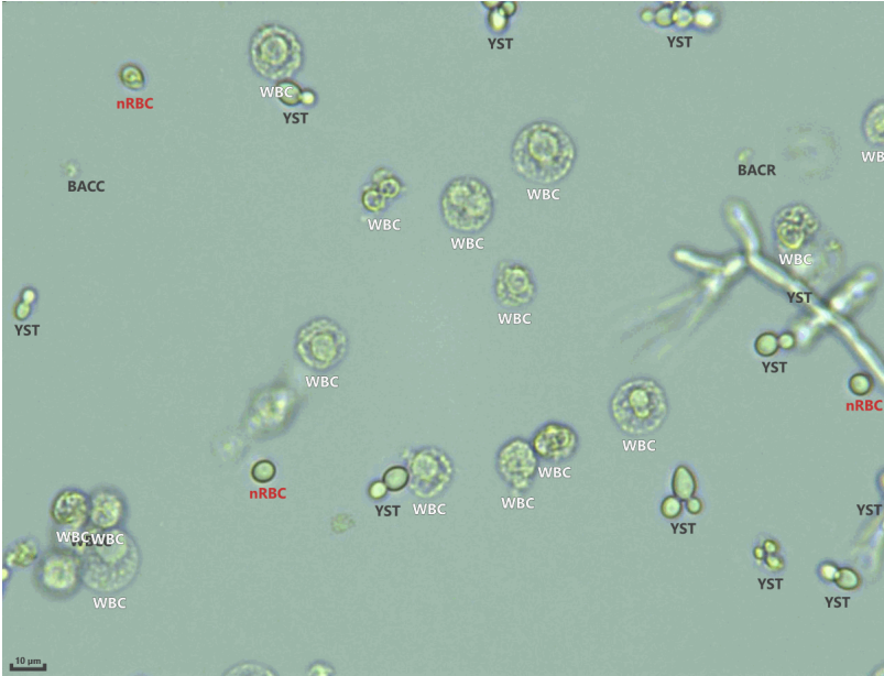 Urine routine microscopy on autoanalyzer showing fungal hyphae and yeast forms with RBC’s and WBC’s.