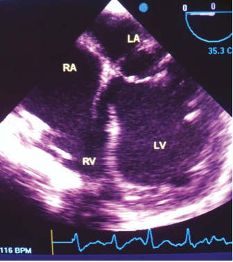 A 4-chamber view at the mid-esophageal level is visualized using transesophageal echocardiography (0 degree). The abbreviations RA (right atrium), LA (left atrium), RV (right ventricle), and LV (left ventricle) are used to label the respective cardiac chambers in this view.