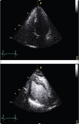 The upper panel of this figure displays contrast echocardiography performed in a patient with suboptimal image quality. It reveals significant apical hypertrophy. In the lower panel, a spade-like left ventricular cavity is observed.