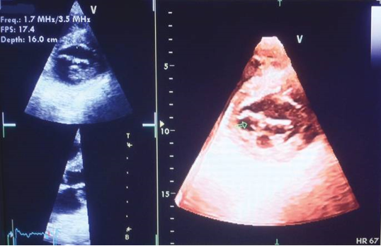 This figure depicts a transverse view at the level of the mitral valve obtained from the parasternal short axis using full-volume 3D imaging. It showcases a patient with prolapse of the posterior leaflet and a visible arrow indicating the presence of ruptured chordae.
