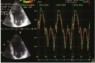 This figure presents offline analyses of tissue Doppler imaging performed on a healthy individual. The analyses were conducted from the apical 4-chamber view, focusing on the basal, middle, and apical segments of the interventricular septum.