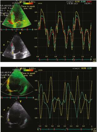 This figure compares the assessment of left ventricular dyssynchrony using tissue Doppler imaging from the apical 4-chamber view in two scenarios. The right panel represents a normal patient, while the left panel represents a patient with left bundle branch block (LBBB). Dyssynchrony was determined by measuring the maximal differences in time-to-peak regional velocity between the septal and lateral walls.