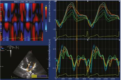 This figure illustrates the evaluation of left atrial (LA) strain and strain rate using velocity vector imaging. The maximum strain measurement was taken during left ventricular (LV) systole, while the strain rate measurement was obtained during the early phase of LV filling.