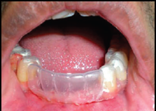 Clear vacuum-formed matrix