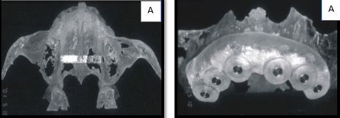 a, b: Computer-assisted design and manufacturing (CAD/CAM) based surgical guide