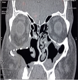 Radiopaque implant seen on axial cut of ct scan of paranasal sinuses