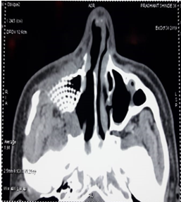 Coronal cuts of ct pns showing the radiopaque implant inserted at the floor of orbit