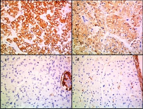 IHC images showing tumour cells expressing; a: CK7 and b: CD117. The tumour cells are negative for c: CD10 and d: Vimentin. (IHCx400)