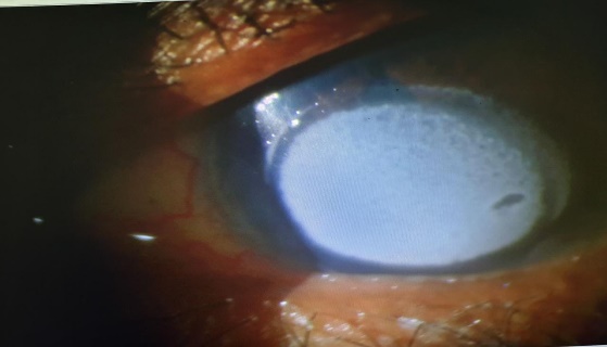 Anterior segment imaging showing corneal deposits