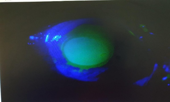 Blue filter showing corneal deposits