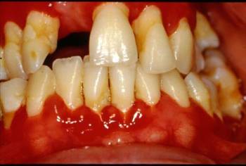 Inflammed gingiva seen in chronic periodontitis (Jonathan A. Ship, MSD Manual)