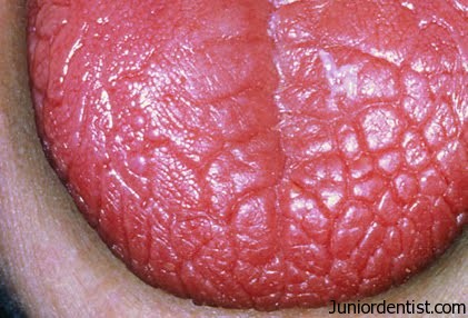Xerostomia (Junior Dentist)