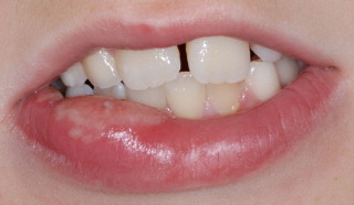 Lip biting (Donald Chi, journal of pediatric Medicine)