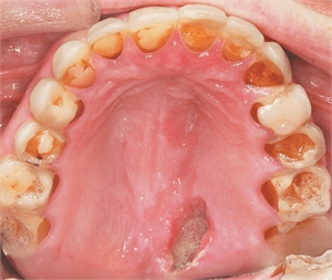 Dental erosion seen in bulimia nervosa (Dentagama)