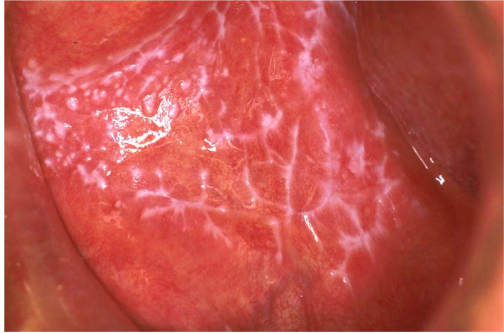 Reticular lesions of lichen planus on oral mucosa (European Association of Oral Medicine)