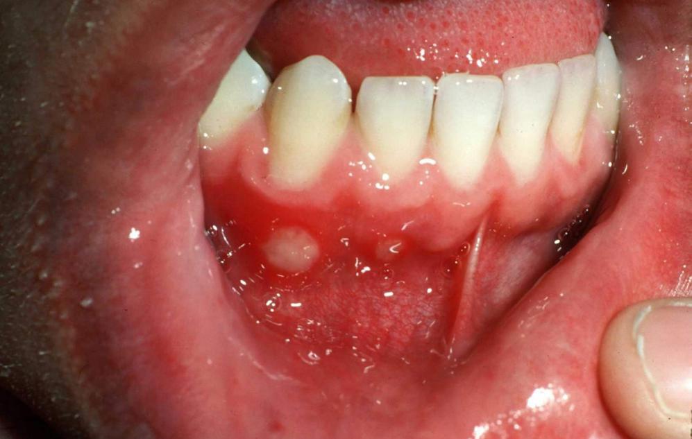 Aphthous ulcer (Health Jade)
