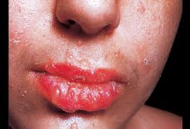 Lip ulcerations seen in erythema multiforme (RxList)