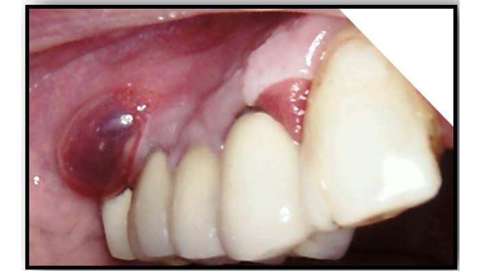 Fluid-filled bulla seen on the buccal mucosa in mucous membrane pemphigoid (Conscientia Beam)