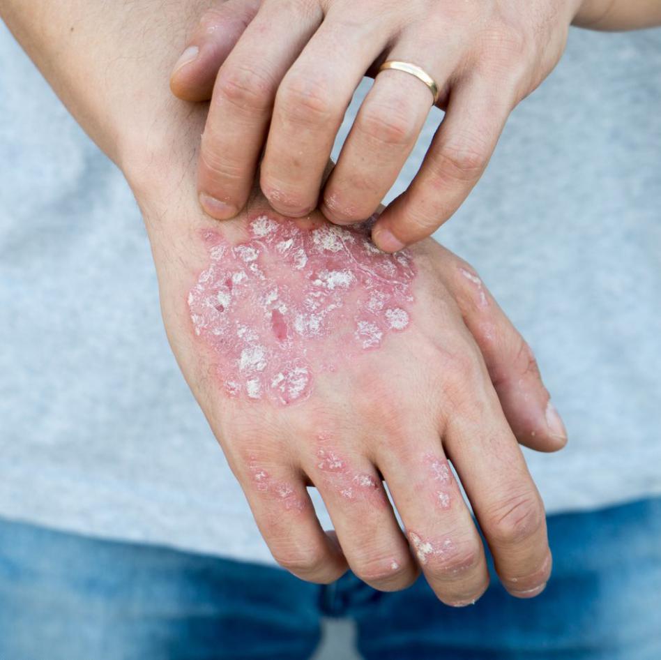 Psoriasis seen on Hands (Jane Bianchi)
