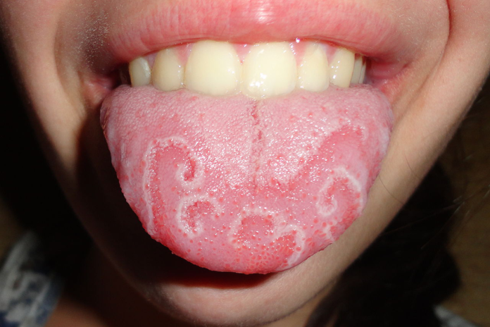 White serpiginous lines seen in geographic tongue (Spring Hatfield)