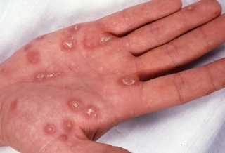 Reactive arthritis seen on palmer Surface of hand (Amy Y-Y Chen)