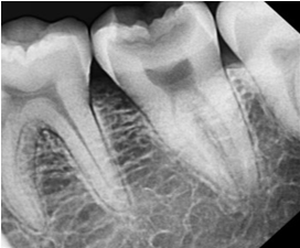 Pre-operative radiograph showing dentinal caries involving pulp #37.