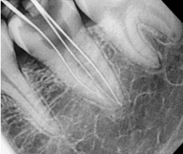 Radiograph showing working length estimation #37.