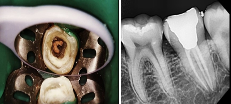 Post operative radiograph #37.