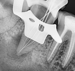 Radiograph showing associated pathology and working length #47.