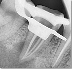 Radiograph showing master cone fit of tooth #47.