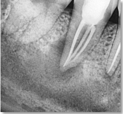 Post operative radiograph #47.