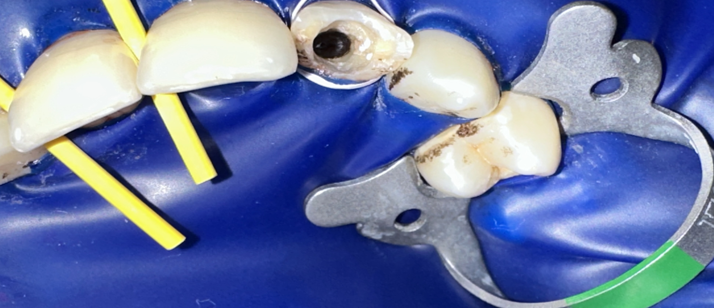 Tooth after MTA Apexification