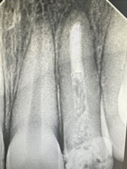 Immediate post operative radiograph