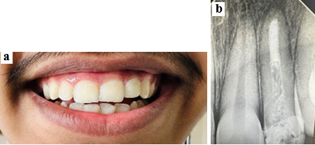 a: Photograph after 1 year follow-up; b: Radiograph after 1 year follow-up