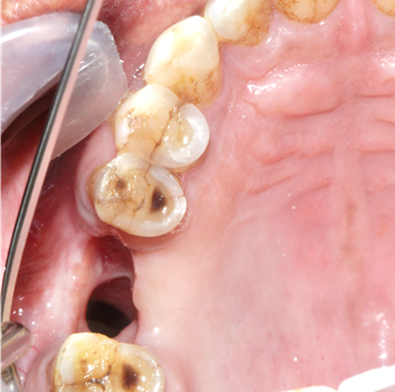 Oroantral fistula in the right maxillary molar region