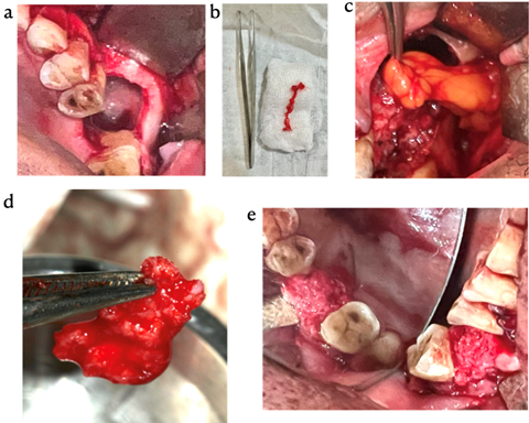 a. Excision of fistula b. Fistula track c. Harvesting buccal fat pad in continuity d. Sticky bone preparation e. Adaptation of sticky bone over the defect