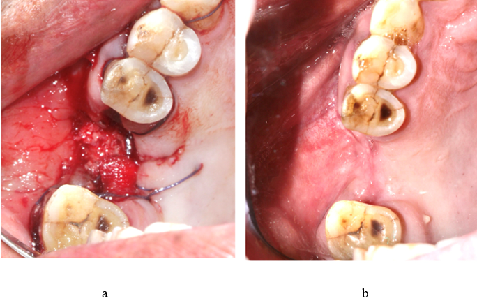 a. Closure using buccal advancement flap and collagen plug. b. 6 Months follow-up