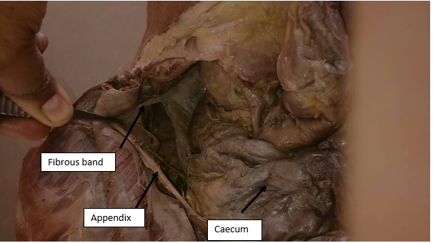Showing the elongated appendix and fibrous band