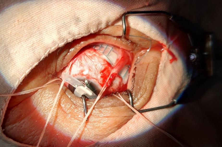 Shows scleral buckle surgery in a patient of RD