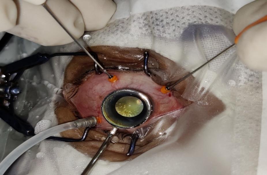 Shows parsplana vitrectomy in a patient of RD