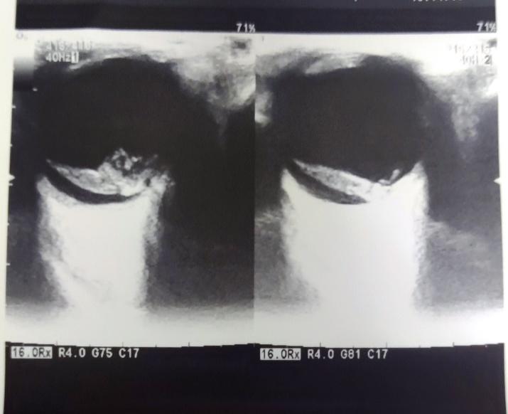 B-scan image of a child showing retinal detachment with thick tractional band