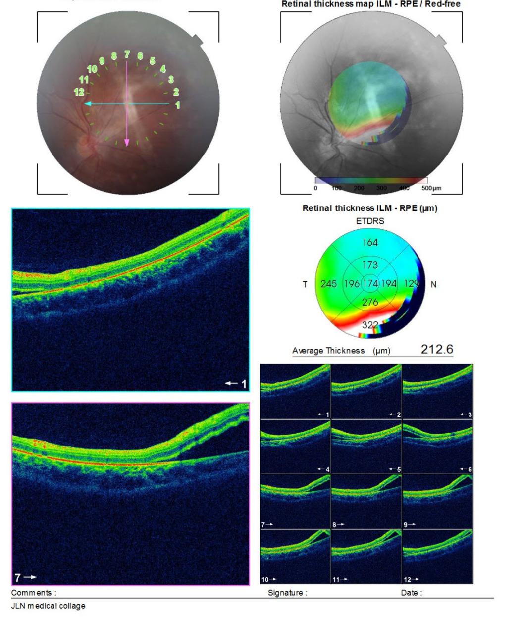 OCT image of a child showing retinal detachment with macula off