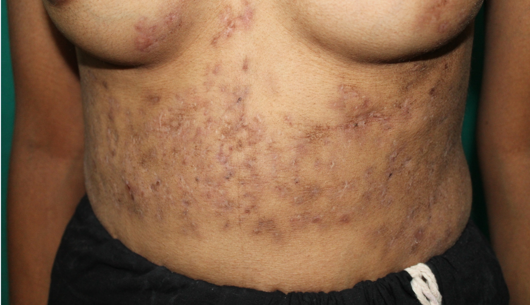 Subsided skin lesions over abdomen and breast