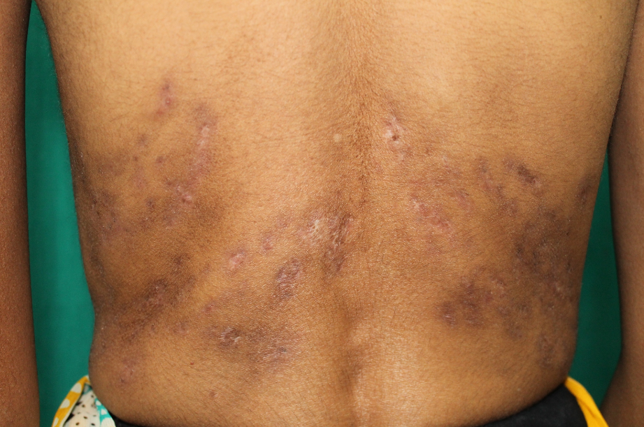 Subsided skin lesions over back