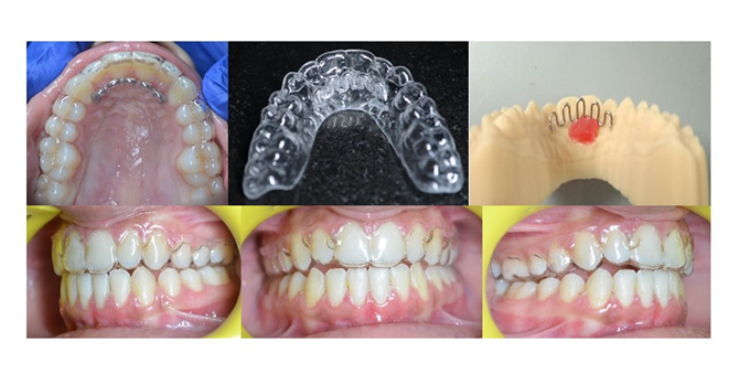  Retainer and appliance
