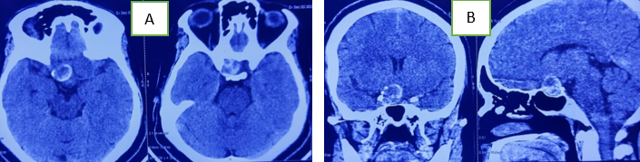 A,B: CT brain showing giant thrombosed supraclinoid aneurysm in right side.
