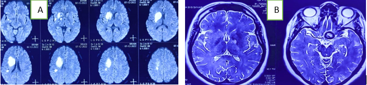 A: MRI brain DWI images showing right side gangliocapsular infarct; B: MRI brain T2WI axial showing Right giant thrombosed supraclinoid aneurysm with gangliocapsular infarct and the aneurysm shows mass effect over the right optic nerve and optic chiasma.