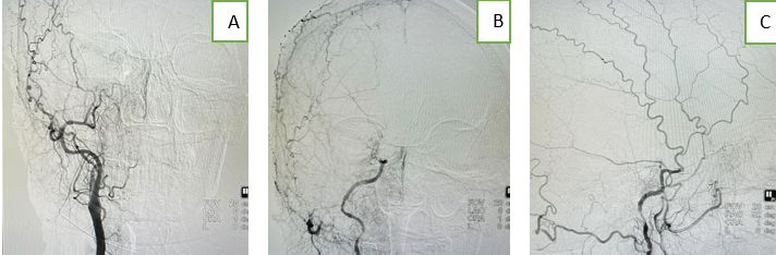 A: DSA contrast injection in right CCA showing good flow in ECA with and reduced flow till clinoid with no flow beyond clinoidal segment; B: DSA contrast injection in right ICA showing reduced filling till clinoid segment of ICA with giant aneurysm in supraclinoid segment; C: DSA contrast injection in right ECA showing good filling in frontal and parietal branches of STA.