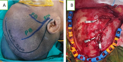 A: Showing frontal and parietal branches of STA marked using Doppler; B: Showing adequate dissection of frontal and parietal branches of STA.
